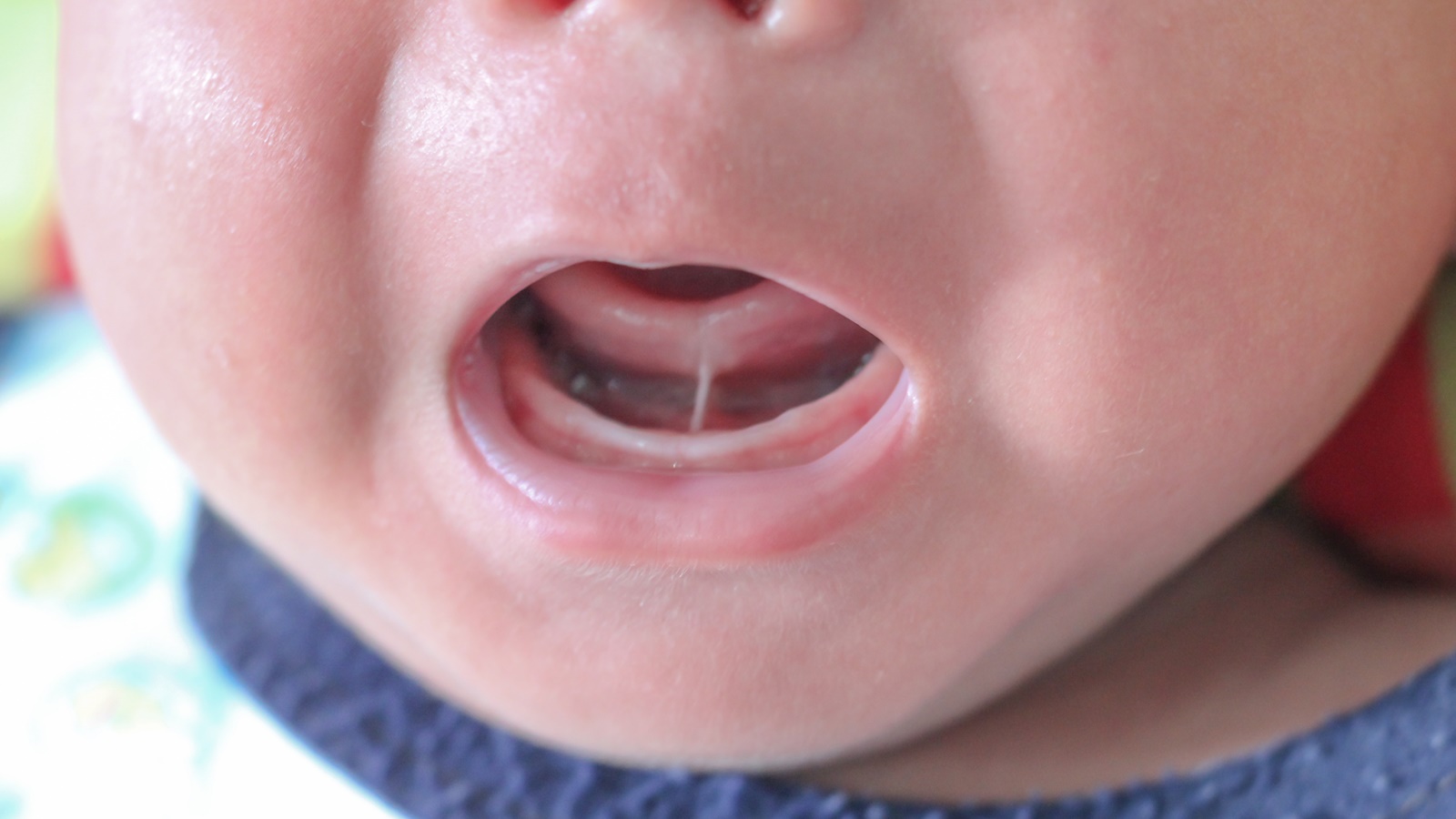Apa Itu Tongue Tie Pada Bayi