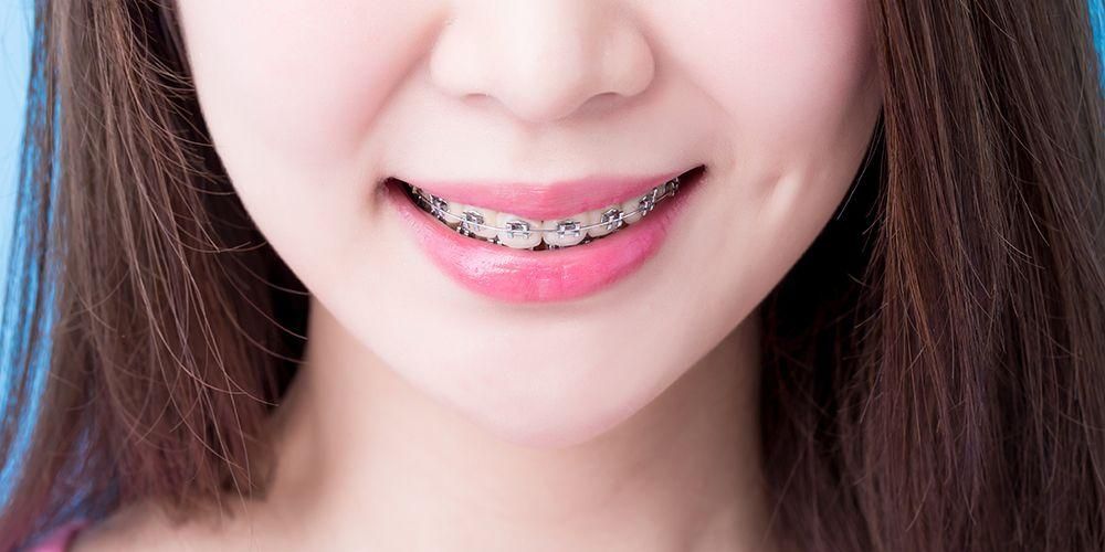 Jenis Gigi Untuk Pakai Braces Apakah Itu Pendakap Gigibraces Kegunaannya Dan Cara Untuk 